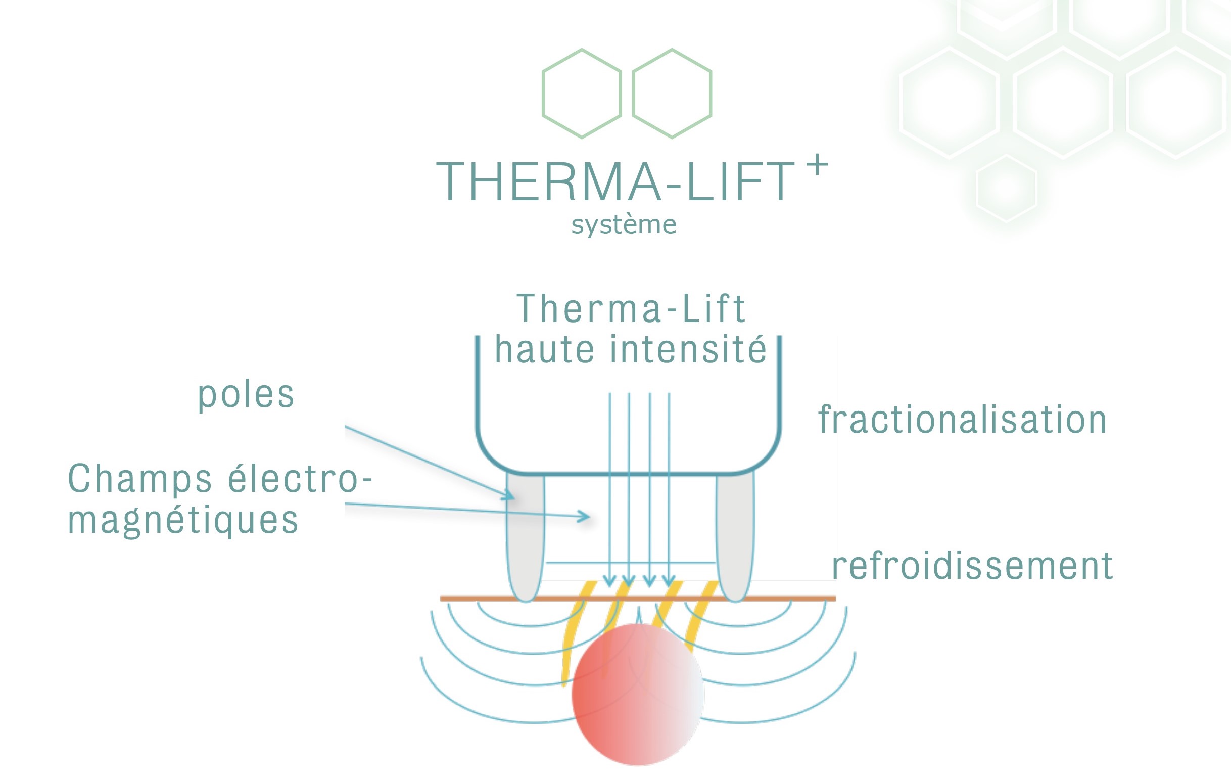 Thermalift - soin avec radiofrequences multipolaires fractionnées